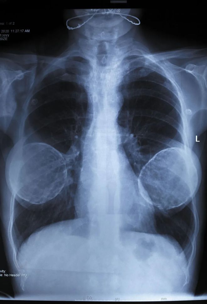 _隆胸物質_隆胸注射物